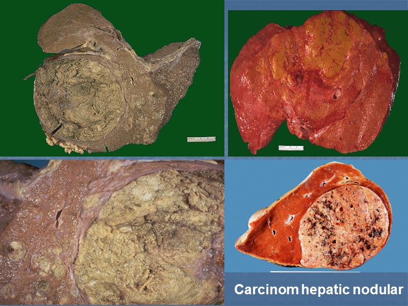 Carcinom hepatic nodular